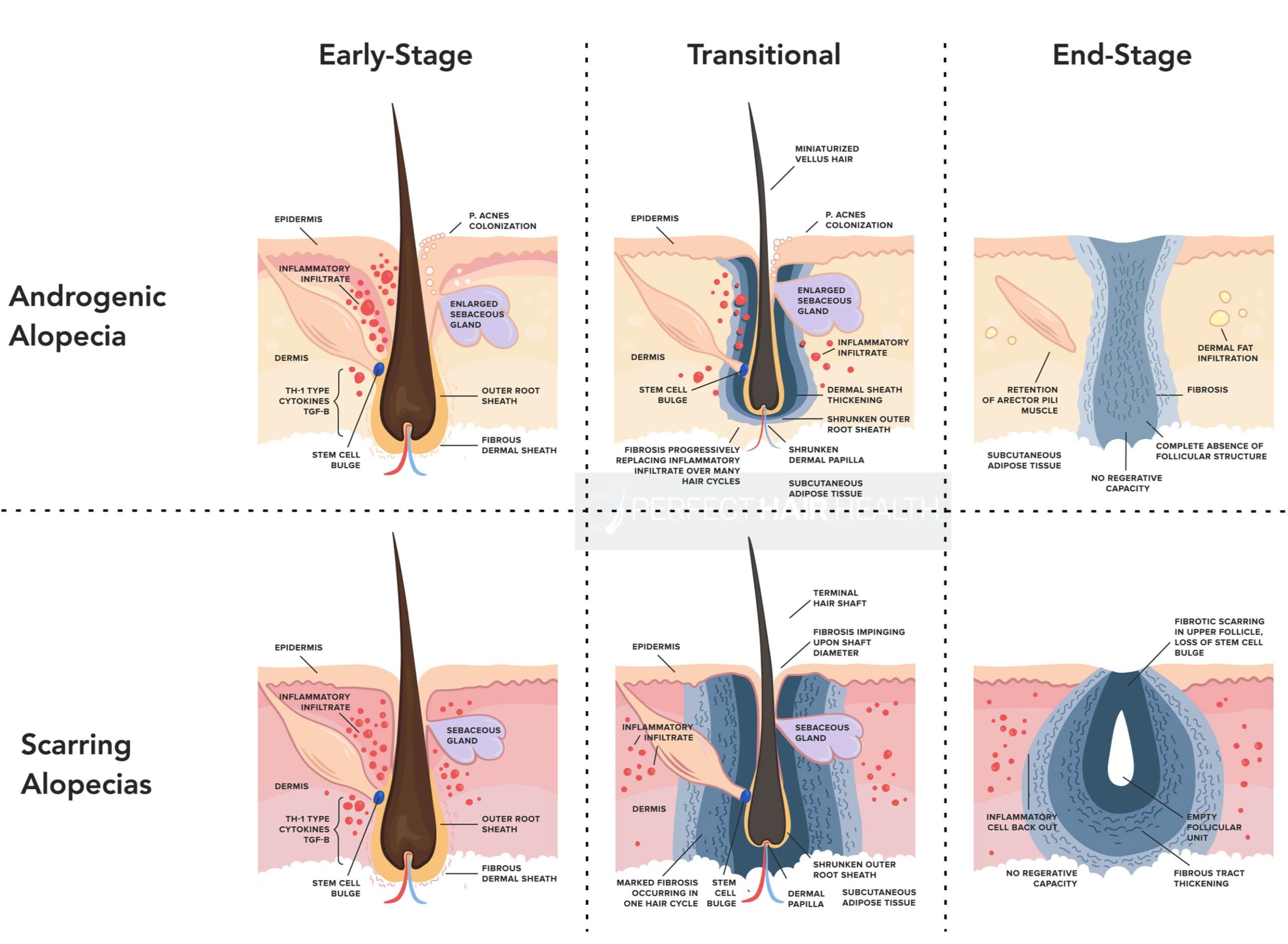 scarring alopecia histology